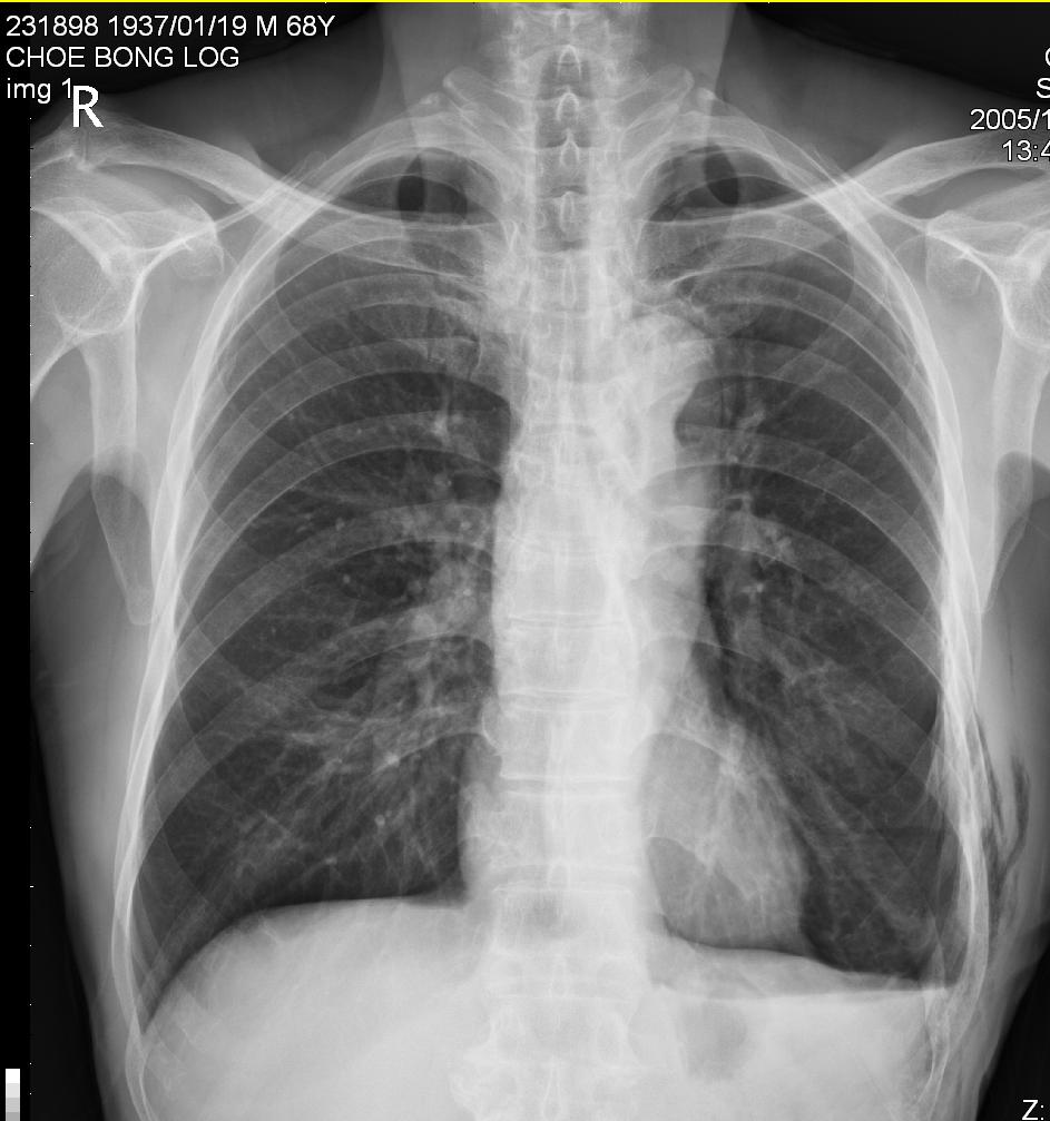 subcutaneous emphysema 네이버 블로그